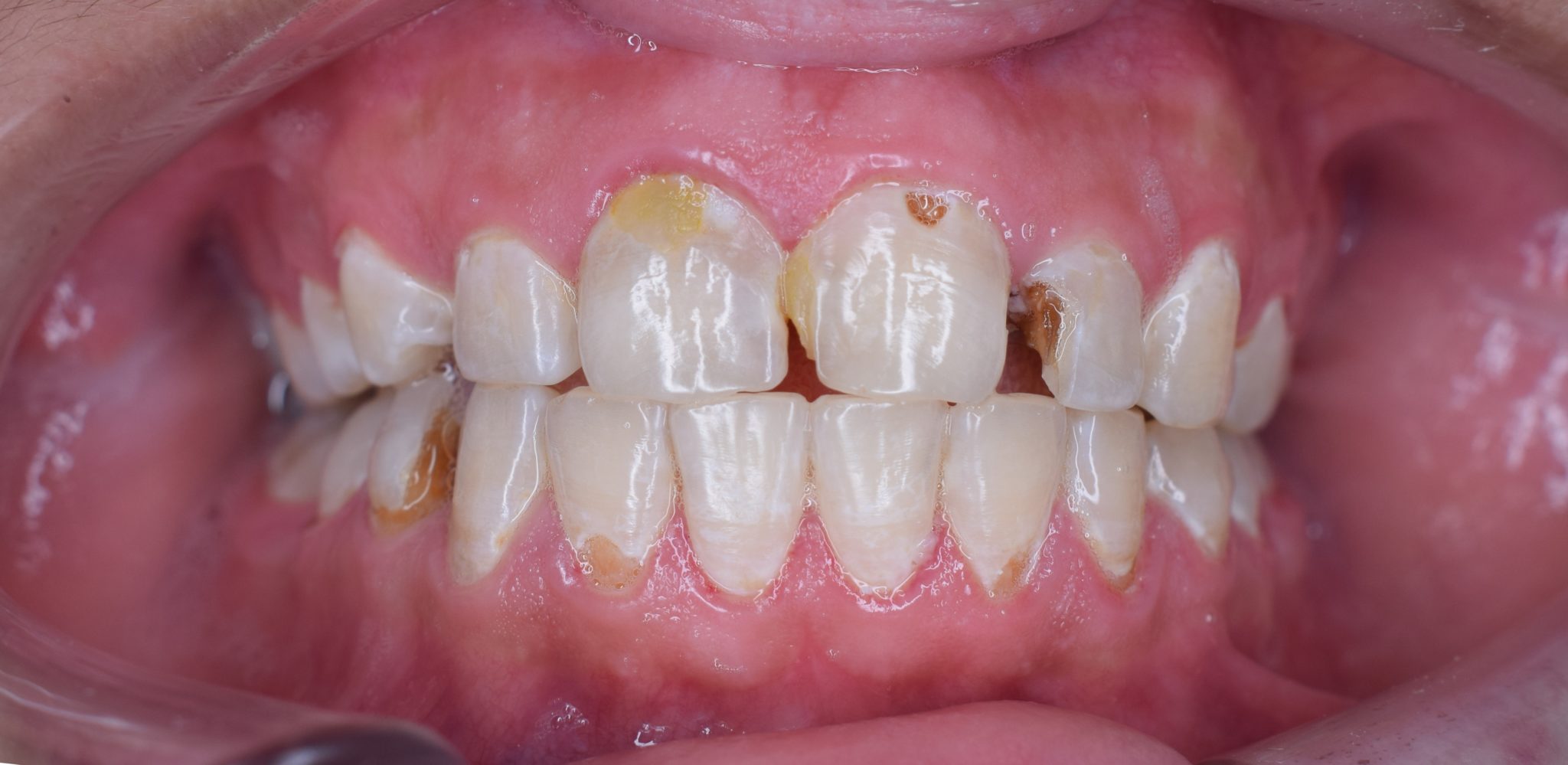 Les Origines Des Caries Dentaires Acg2016 Odontologie